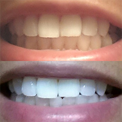 smilebrilliant-results-4